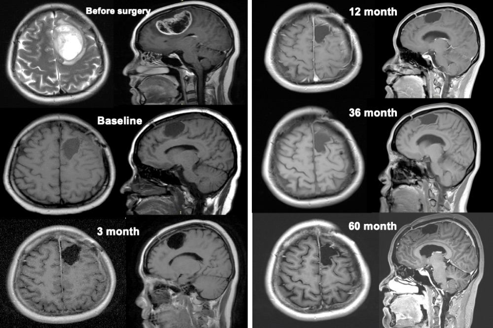 Series of MRI scans of the published case from before surgery to 60 months